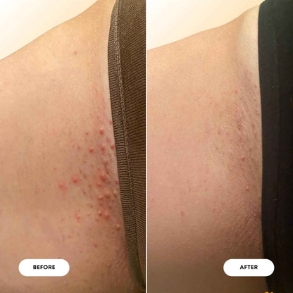 Bushbalm Ingrown Hair Oil - Helps Reduce, Repair Skin from Ingrown Hairs, Razor Bumps & Underarm Bumps - Soothe Skin from Post Shave Itchiness 30 ml - Vanilla Tangerine Oil - Formerly Sweet Escape 🍁 All In One Marketplace Canada