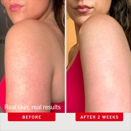 First Aid Beauty KP Bump Eraser Body Scrub, 10% AHA Keratosis Pilaris Exfoliator - Glycolic & Lactic Acid with Pumice, Treatment for Strawberry Legs, Razor Bumps & Rough Bumpy Skin, Safe for Sensitive Skin, 10 oz, Unscented 🍁 All In One Marketplace Canada